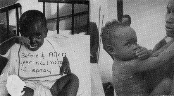 [Before and after photograph of a child treated for leprosy]