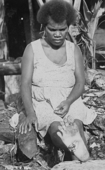 Tropical ulcer in Papua New Guinea