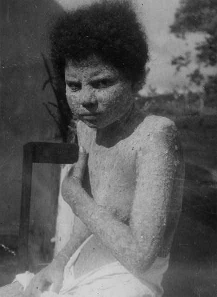 A Paraguaian Indian under treatment at Penfigo Adventist Hospital, Mato Grosso (Campo Grande), Brazil