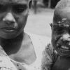 New Guinea child with the yaws.