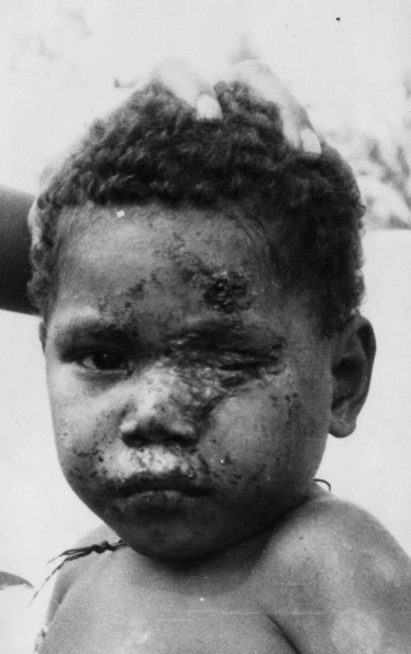 Young child on Malaita suffering from Yaws. He has just been brought in for his 2nd injection. One week previously he was much worse  improvement due to penicillin.