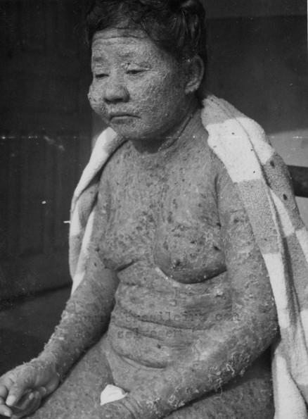 A patient for treatment of Fogo Salvagem at Penfigo Hospital in Brazil