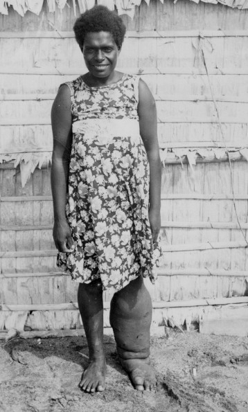 People in New Guinea with yaws