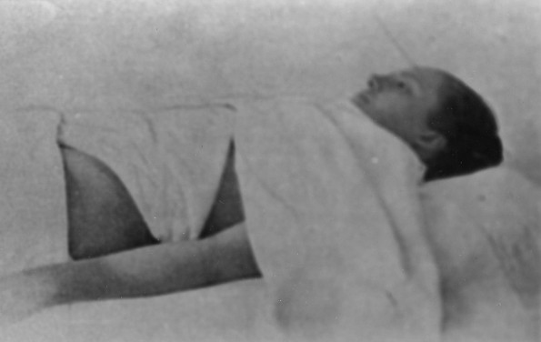 Battle Creek Sanitarium patient undergoing a weighted compress treatment