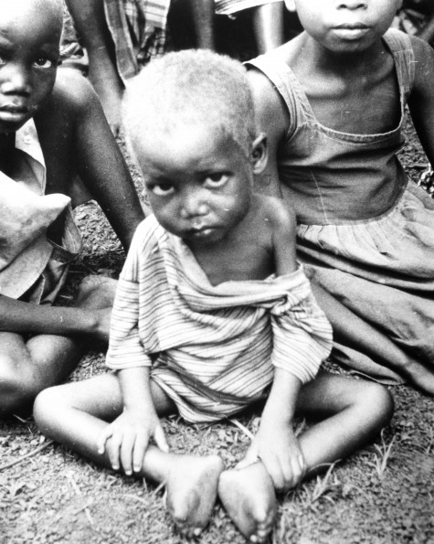 Malnurished African children
