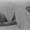 Battle Creek Sanitarium patient undergoing a weighted compress treatment