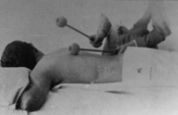 Battle Creek Sanitarium patient undergoing percussive treatment